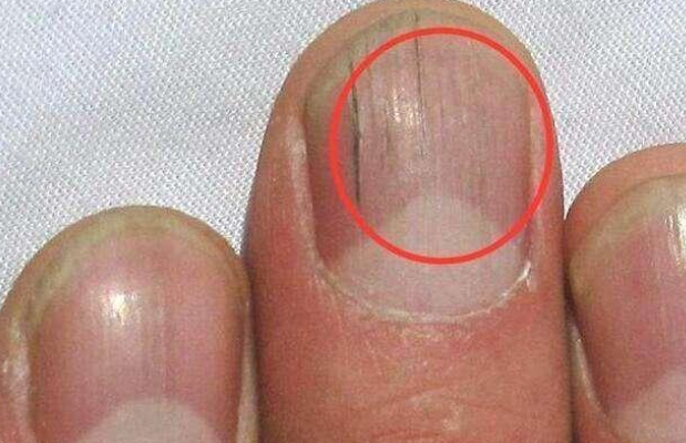 指甲有竖纹是身体的什么信号