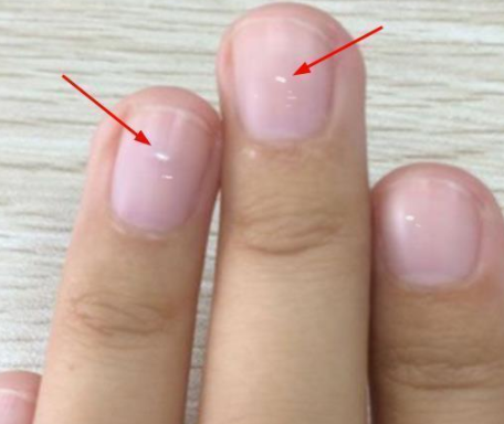 指甲有竖纹是身体的什么信号