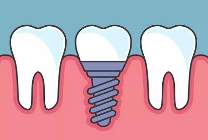 种植牙的五大危害(种植牙的全部过程)