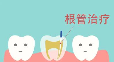 根管治疗多少钱一颗牙(上海根管治疗多少钱一颗牙)
